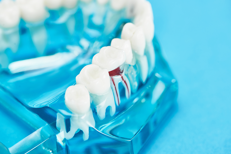 根管治療（歯内療法）